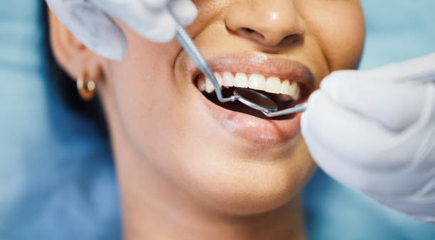 Best Emergency Dentist for Lost Fillings or Crowns in Tuscoosa, AL