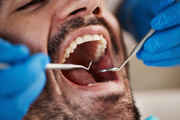 Best Emergency Dentist for Lost Fillings or Crowns in Tuscoosa, AL