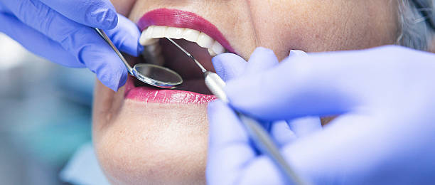 Best Emergency Dentist for Lost Fillings or Crowns in Tuscoosa, AL